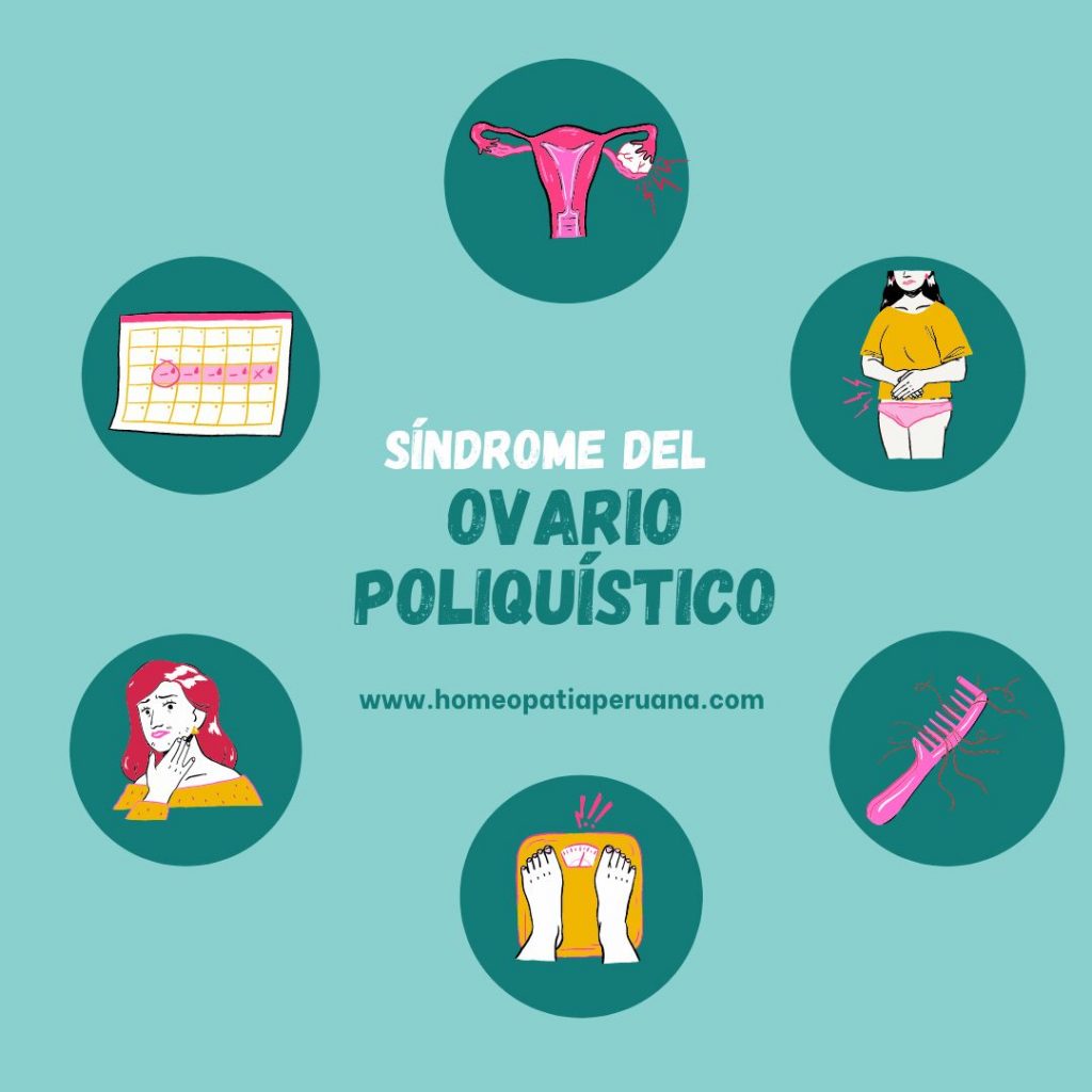 Síndrome del ovario poliquístico (SOP)